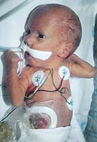 Patau Syndrome Patau (3).jpg